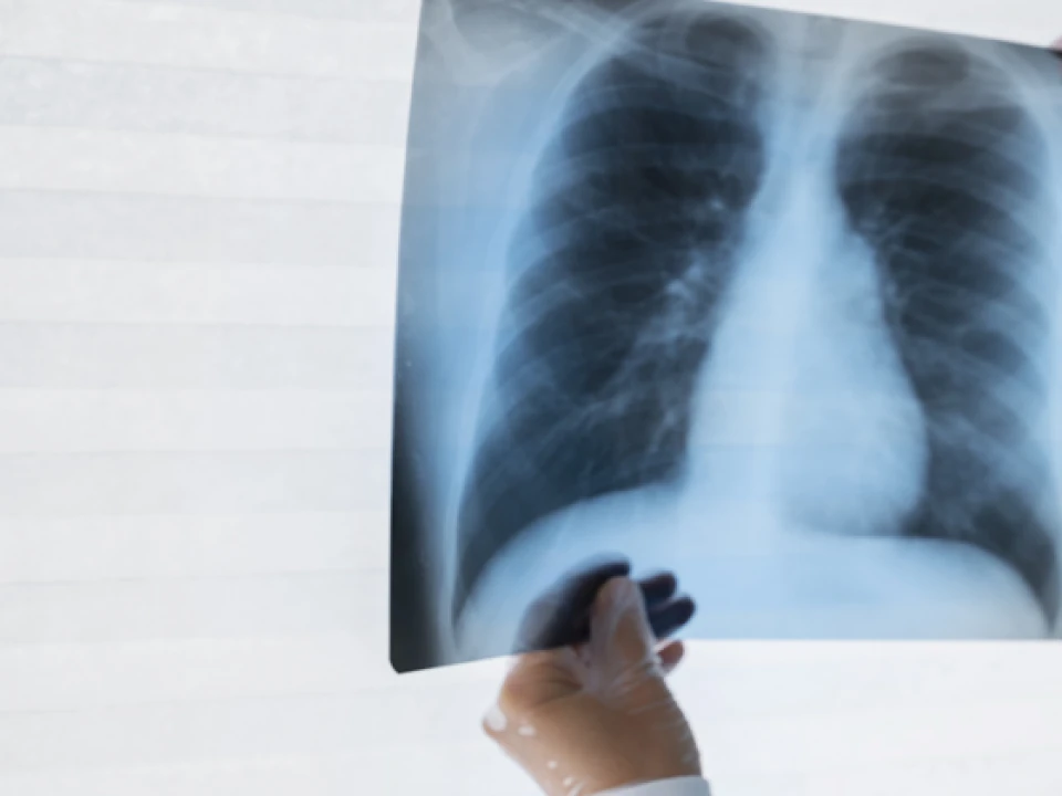 Meski Berbahaya, Tuberkulosis Bisa Disembuhkan